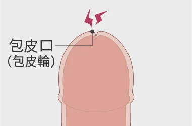 通常時・勃起時も全くむけない状態