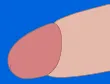 陰茎増大術のイラスト